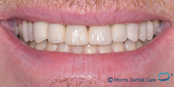 After the treatment which involved clear aligners, composite bonding and teeth whitening our patient was delighted with the confidence having a balanced and whiter smile. 